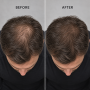 RadiaAura™ Halo LED Scalp Cap
